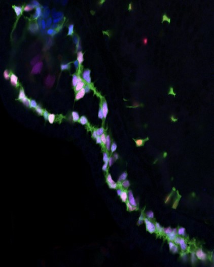 Jagged Notch Signaling | Alagille Syndrome 4